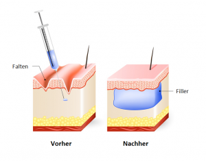 Beispiel von Faltenunterspritzung mit Hyaluronsäure