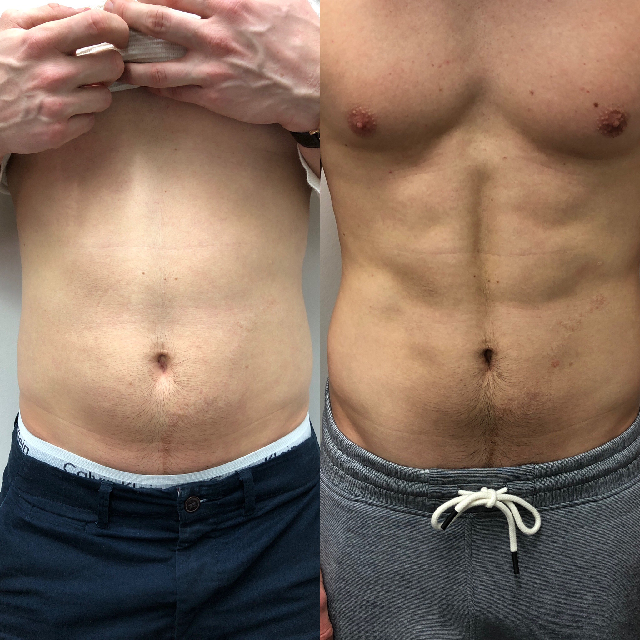 EmSculpt-Behandlung Mann Bauch Vorher Nachher.