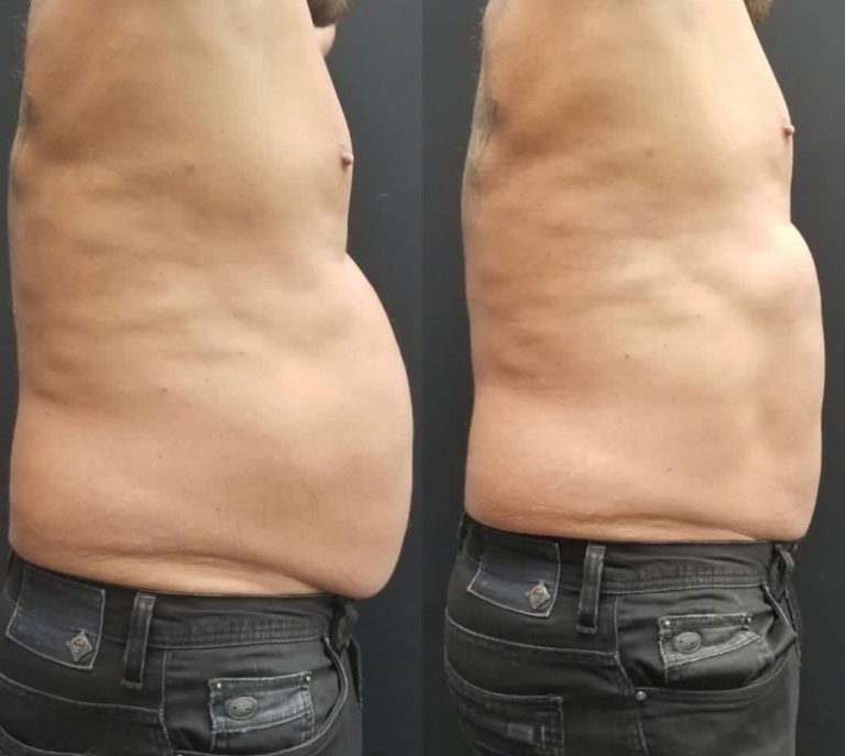 EmSculpt-Behanldung-Bauch-Mann - Dr. Aesthetik