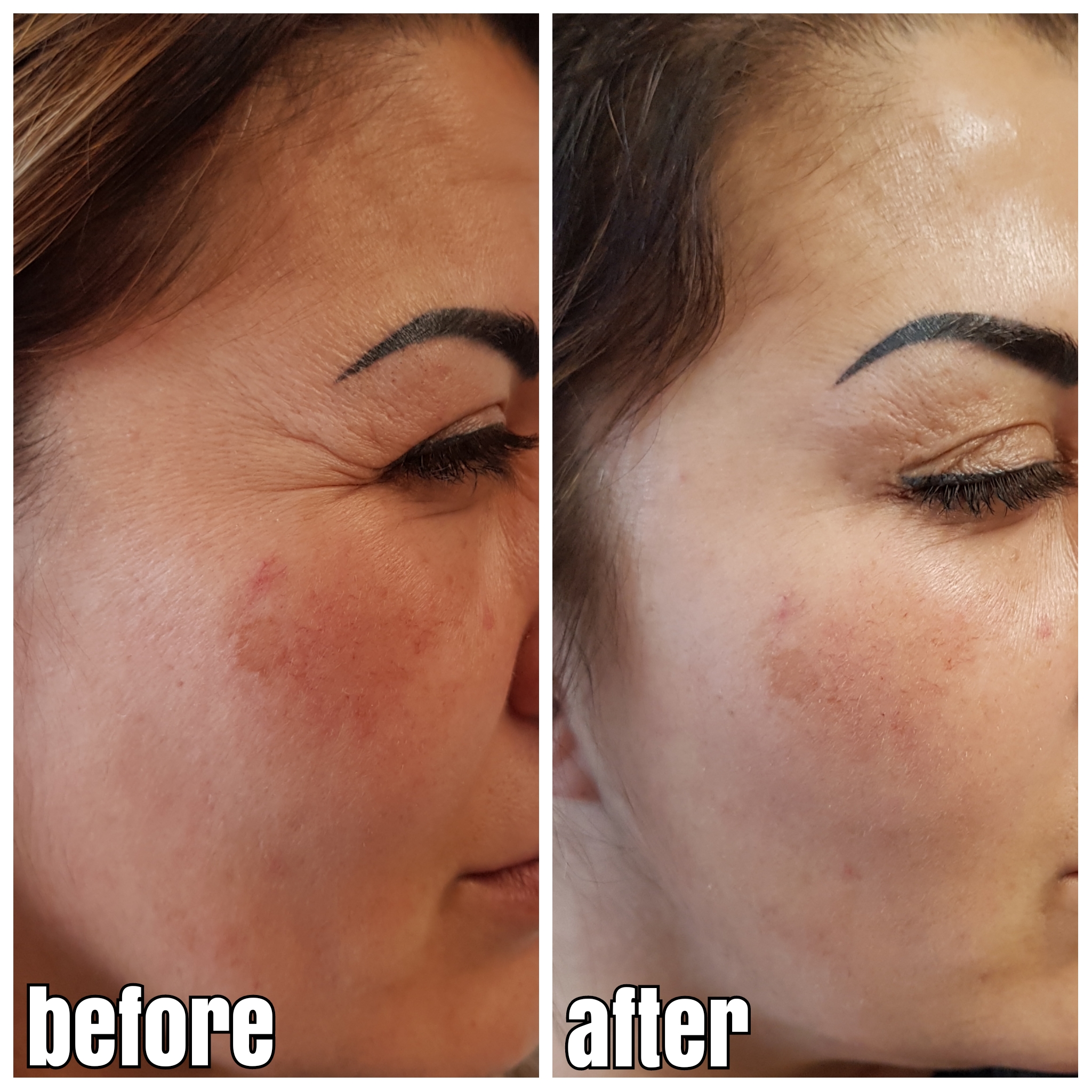 KraehenfuesseVorherNachher03 Dr. Aesthetik