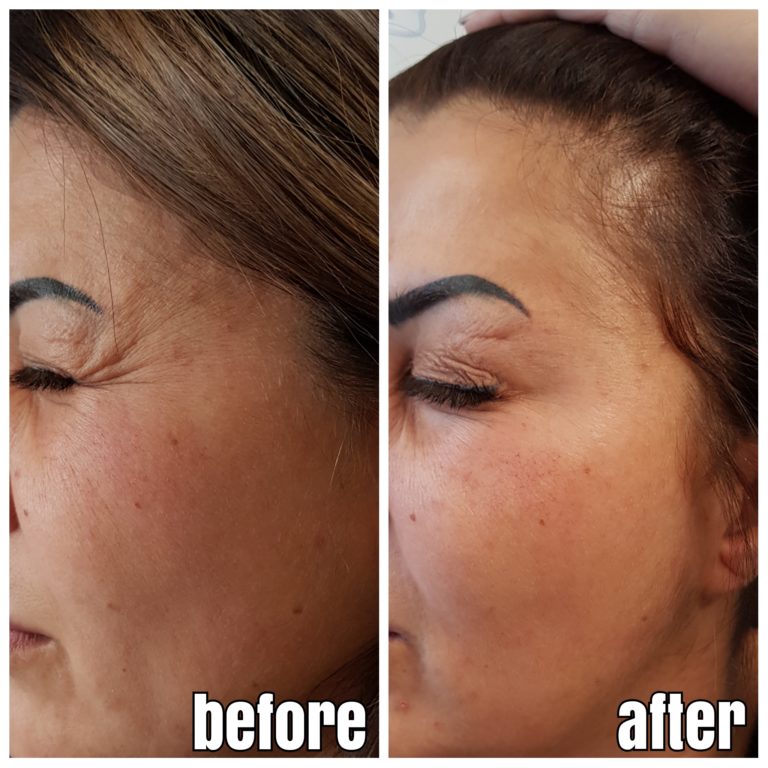 KraehenfuesseVorherNachher04 Dr. Aesthetik