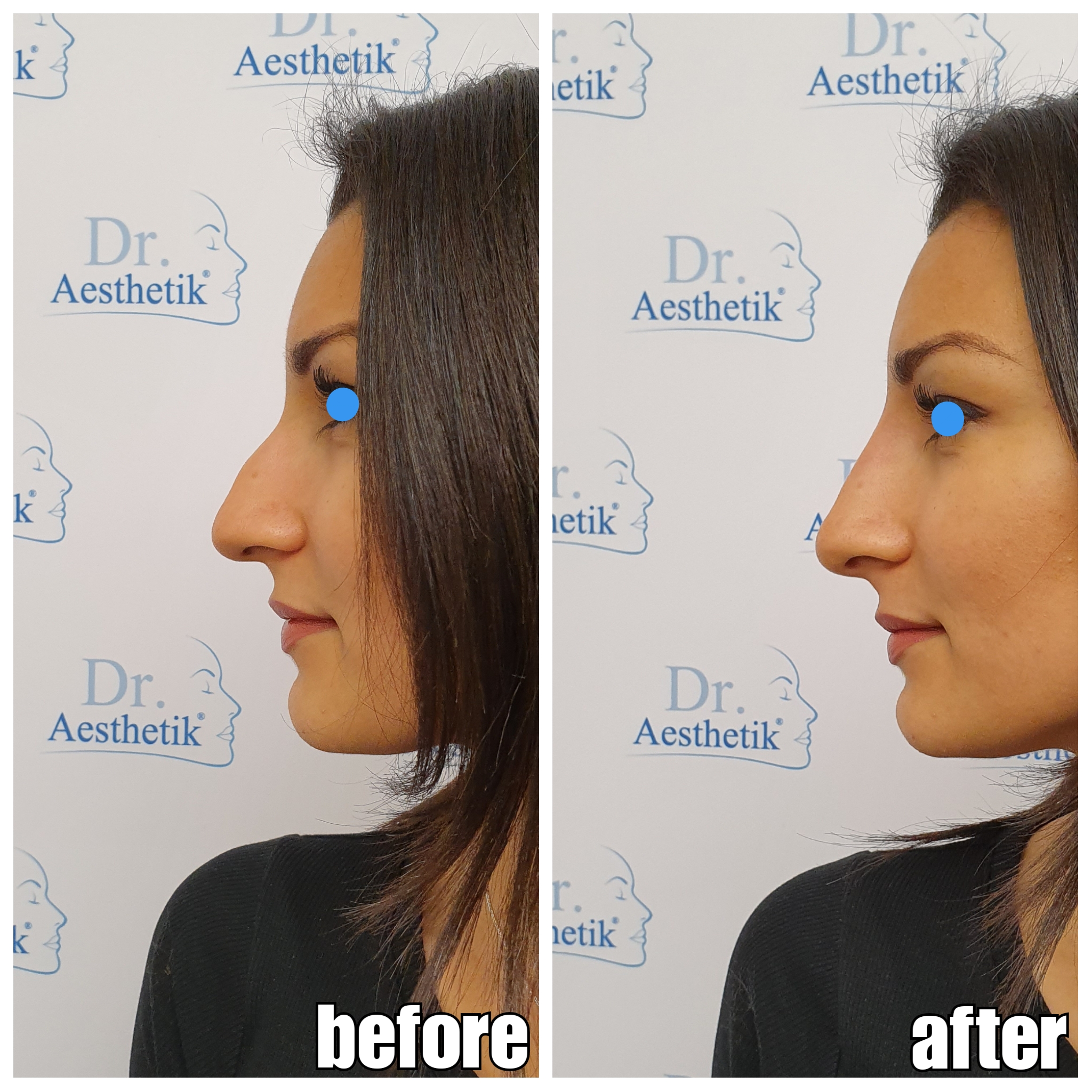 NassenkorrekturVorherNachher27 Dr. Aesthetik NassenkorrekturVorherNachher27 Dr. Aesthetik