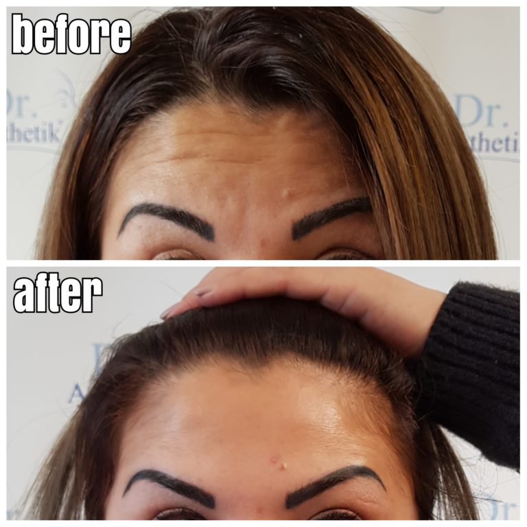 StirnfaltenVorherNachher02 Dr. Aesthetik