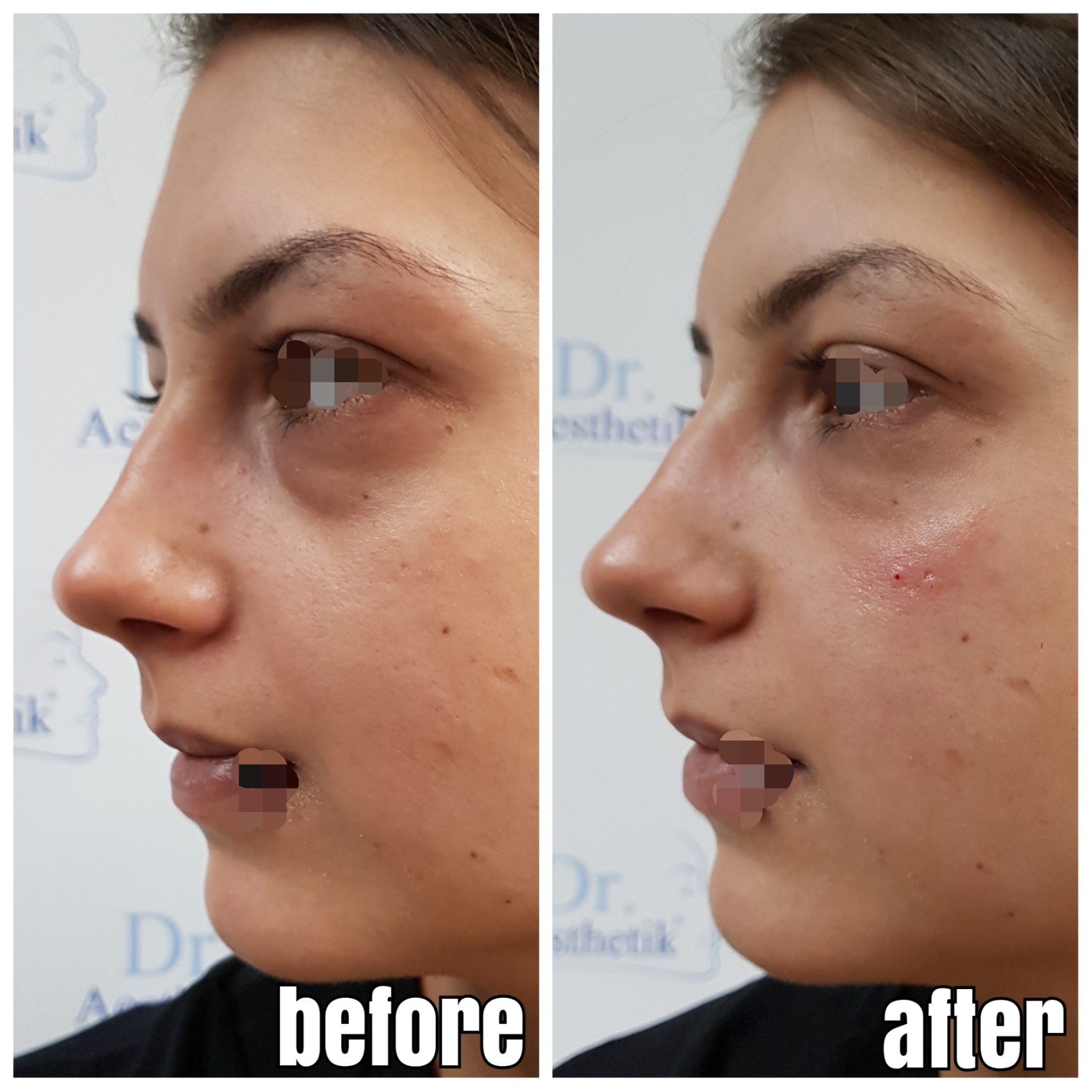 TraenenfurcheVorherNachher06 Dr. Aesthetik