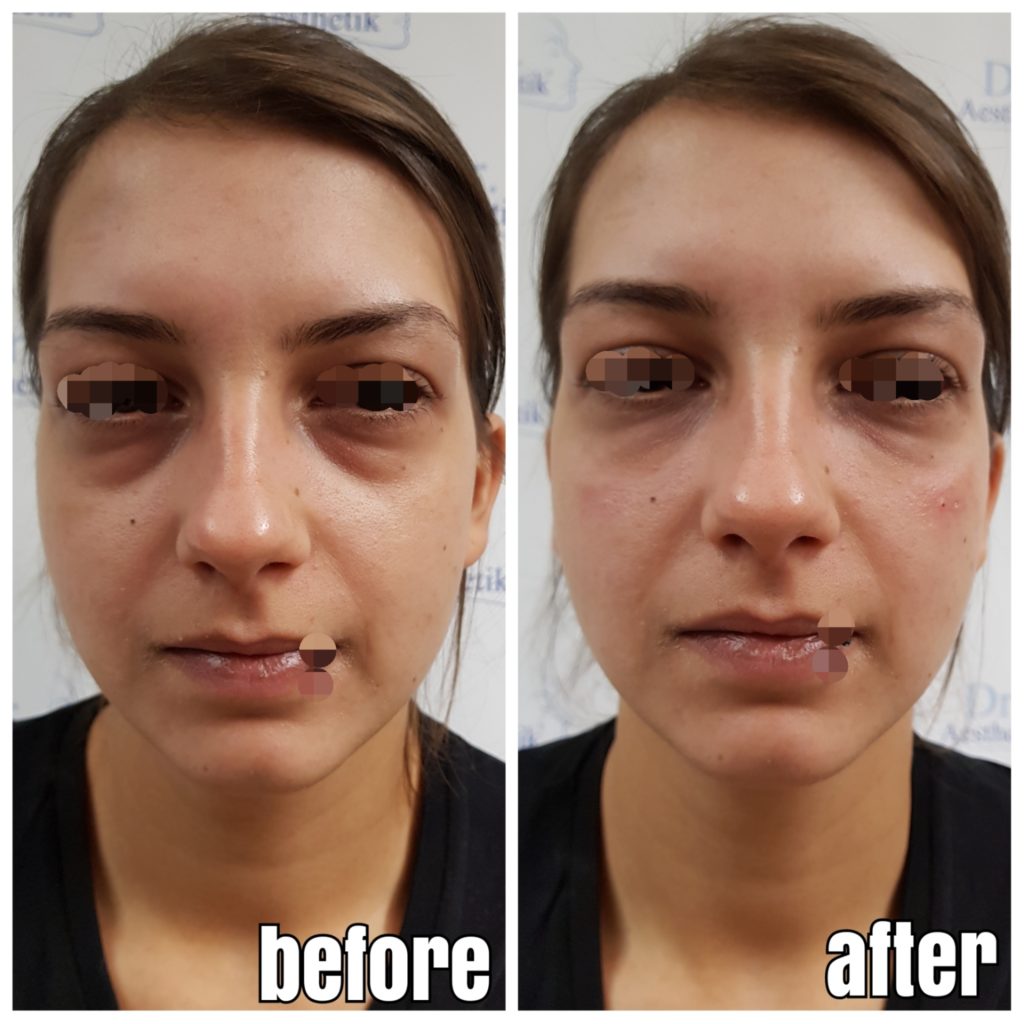 TraenenfurcheVorherNachher08 Dr. Aesthetik