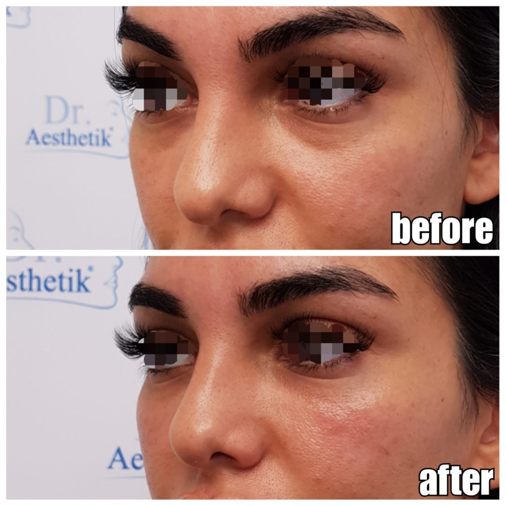 TraenenfurcheVorherNachher24 Dr. Aesthetik