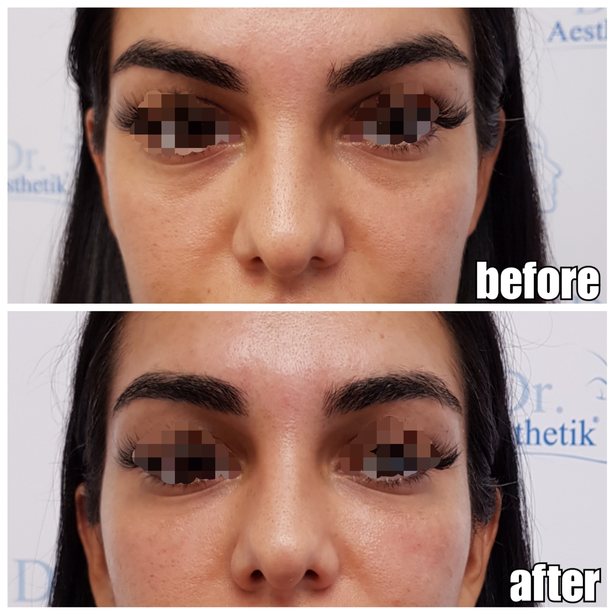 TraenenfurcheVorherNachher26 Dr. Aesthetik