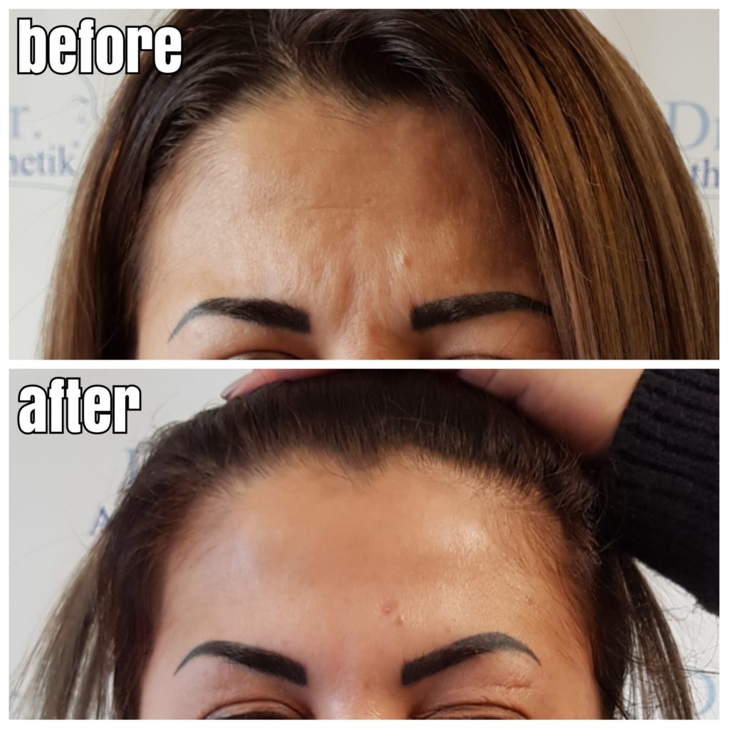 ZornesfalteVorherNachher2 Dr. Aesthetik